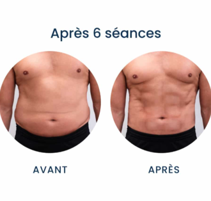 Ultra sculpt Lasers Machines